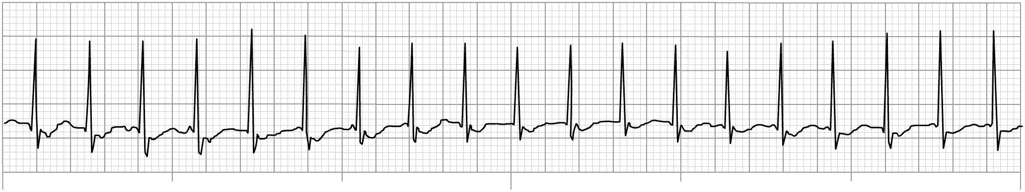 Six Second ECG Practice Quiz 2A - SkillStat