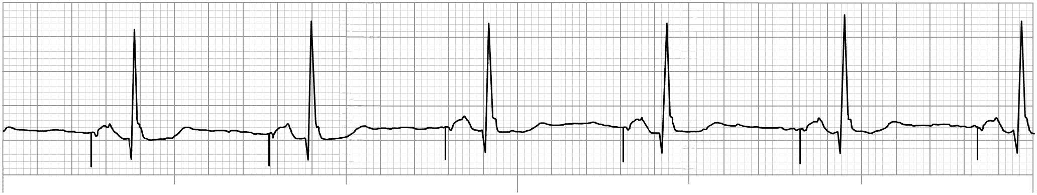 Six Second ECG Practice Quiz 3A - SkillStat